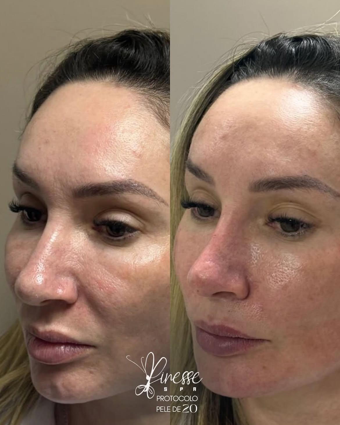 Antes e depois, Protocolo Pele de 20 1